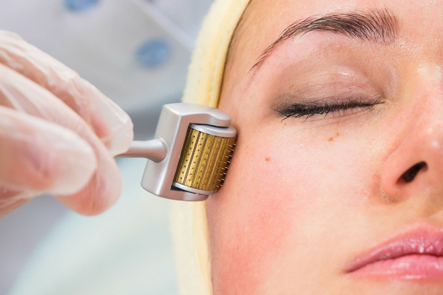microneedling che cos'è